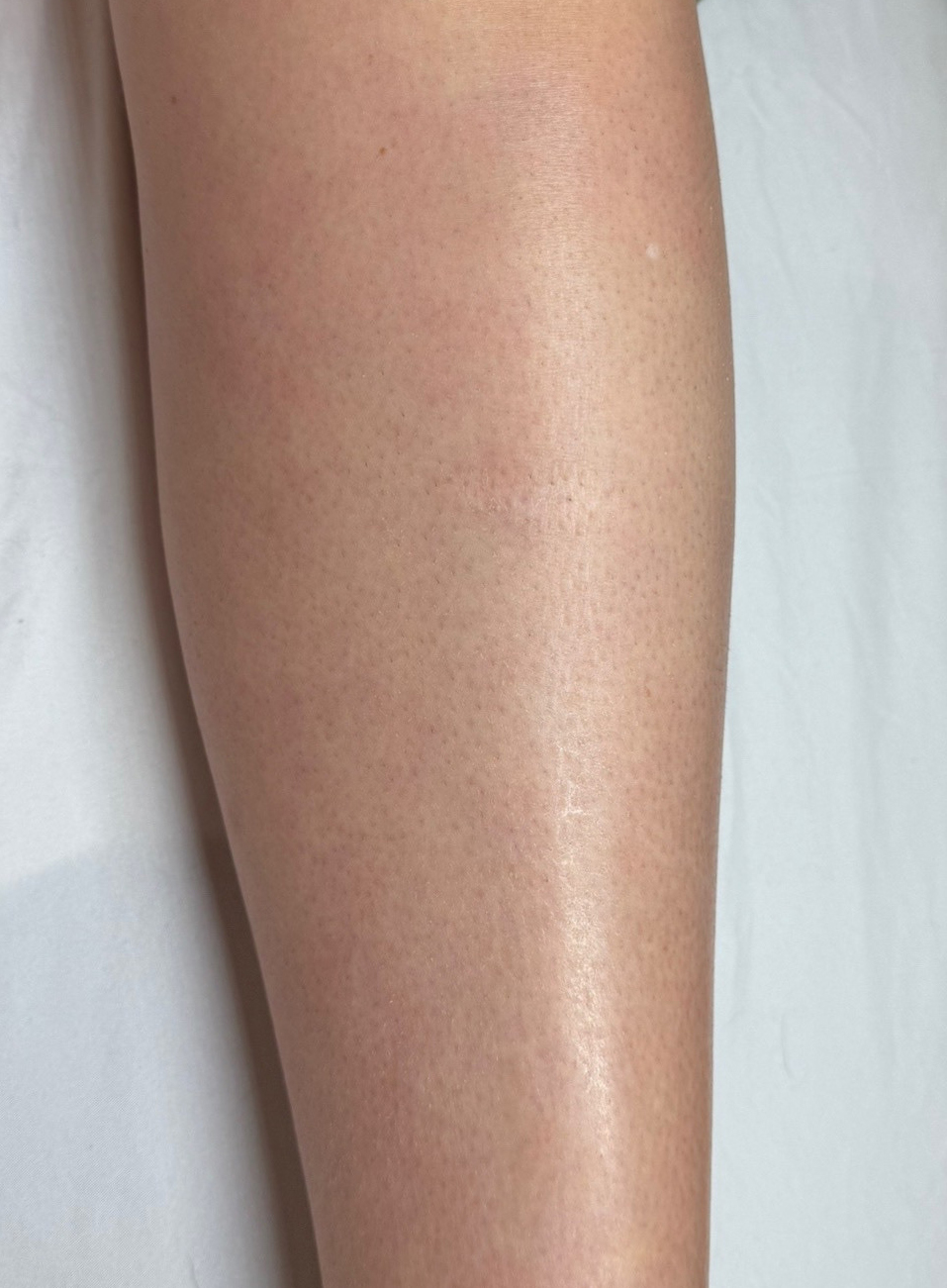 After IPL Laser Hair Removal at AZ Beauty Studio & Training Academy