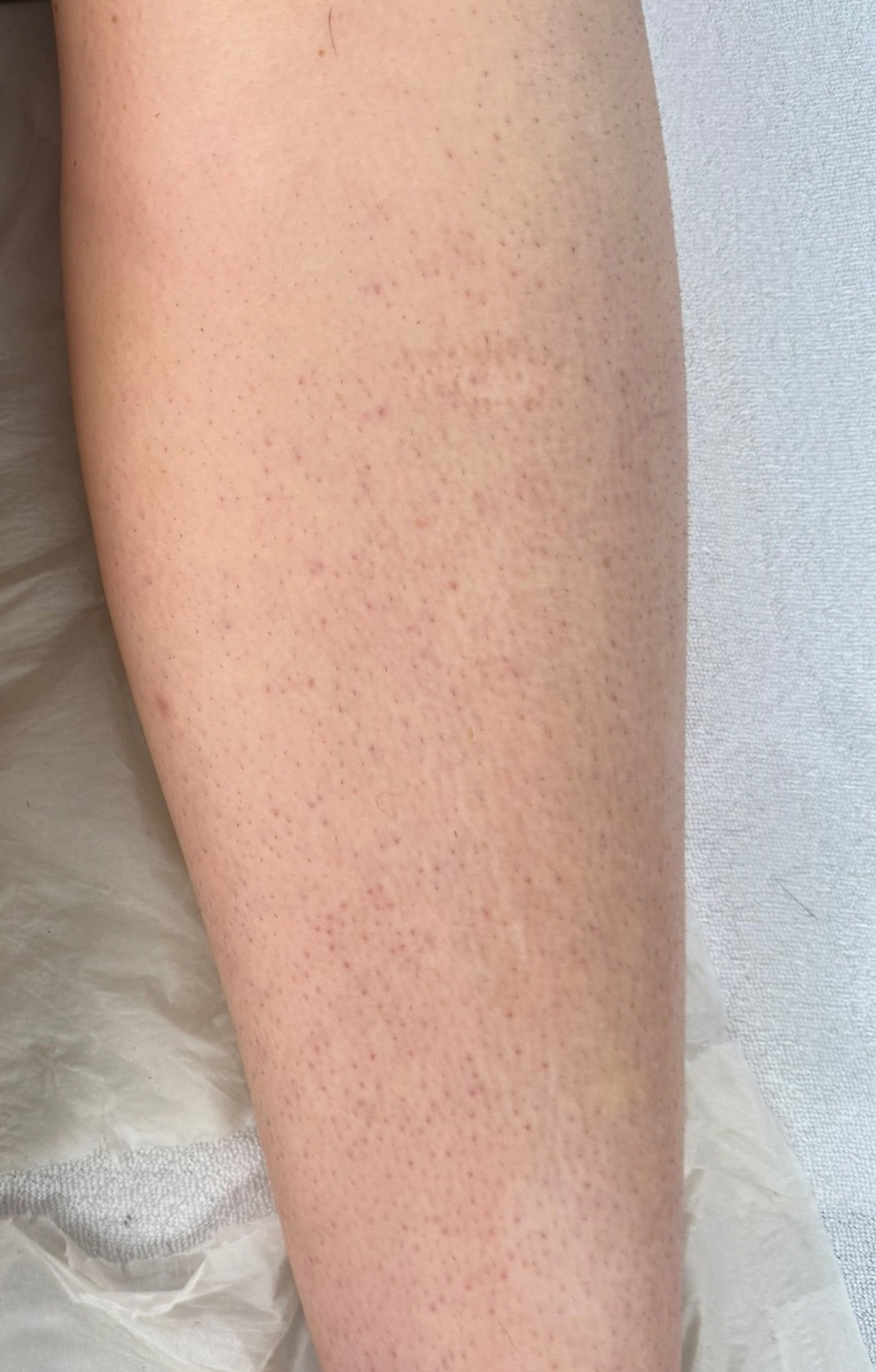 Before IPL Laser Hair Removal at AZ Beauty Studio & Training Academy